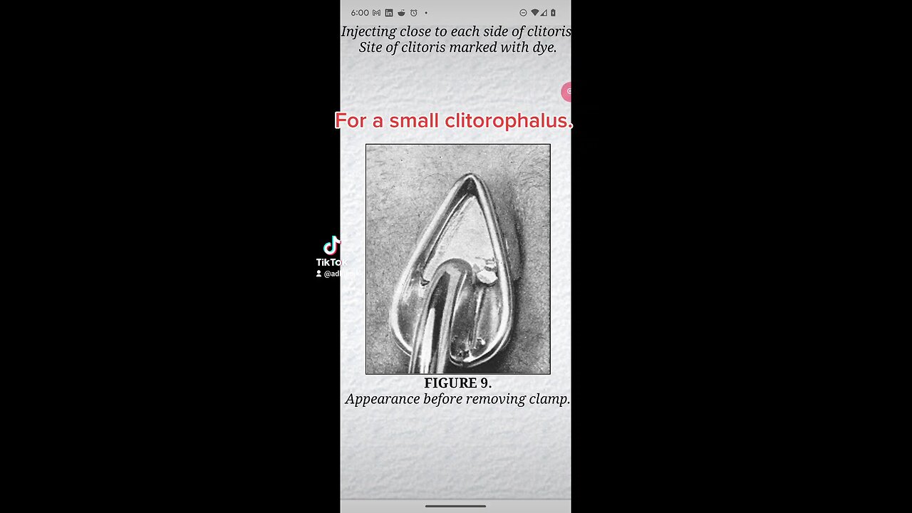 Small and large clitorophallus trimmers