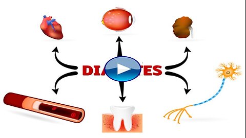Diabetes to kill 1 million Americans by 2030