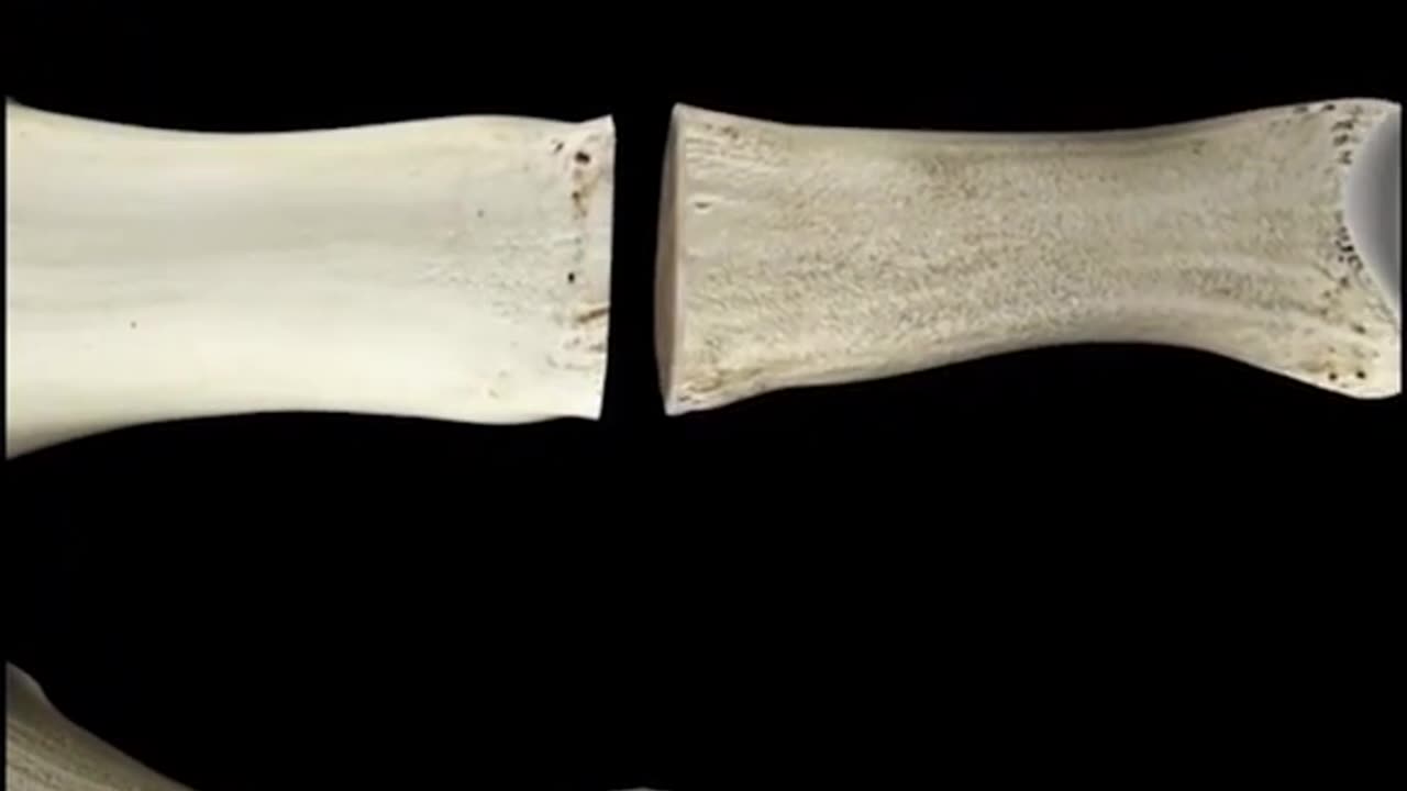 Joint Fusion Surgery 3D Animation