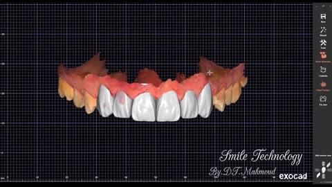 #design #naildesign #dental #dentaldesign #exocadexpert