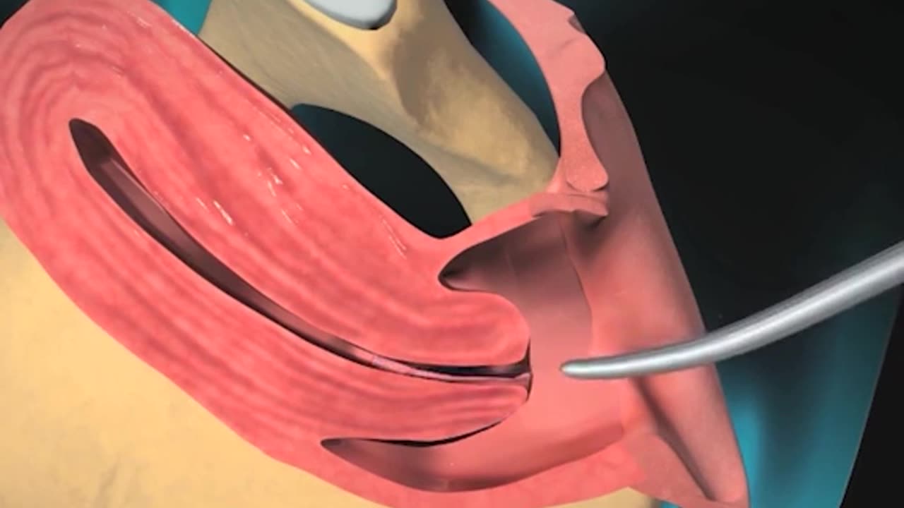 Hysteroscopy Procedure 3D Animation