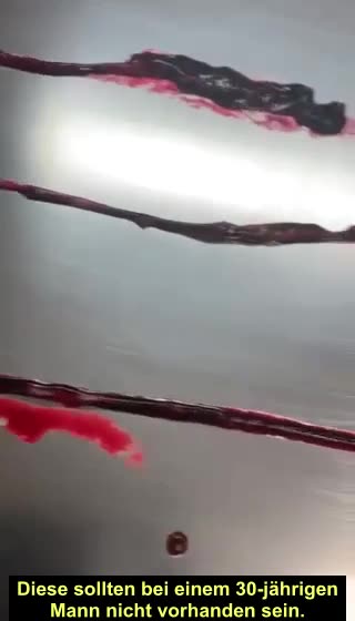 Bestatter John O'Looney zeigt massive Blutgerinnsel eines 30-jährigen Mannes