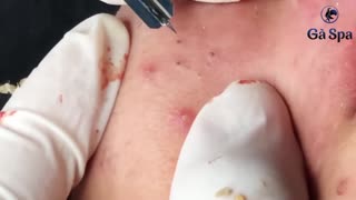 Satisfying blackhead removal and Pimplepopping