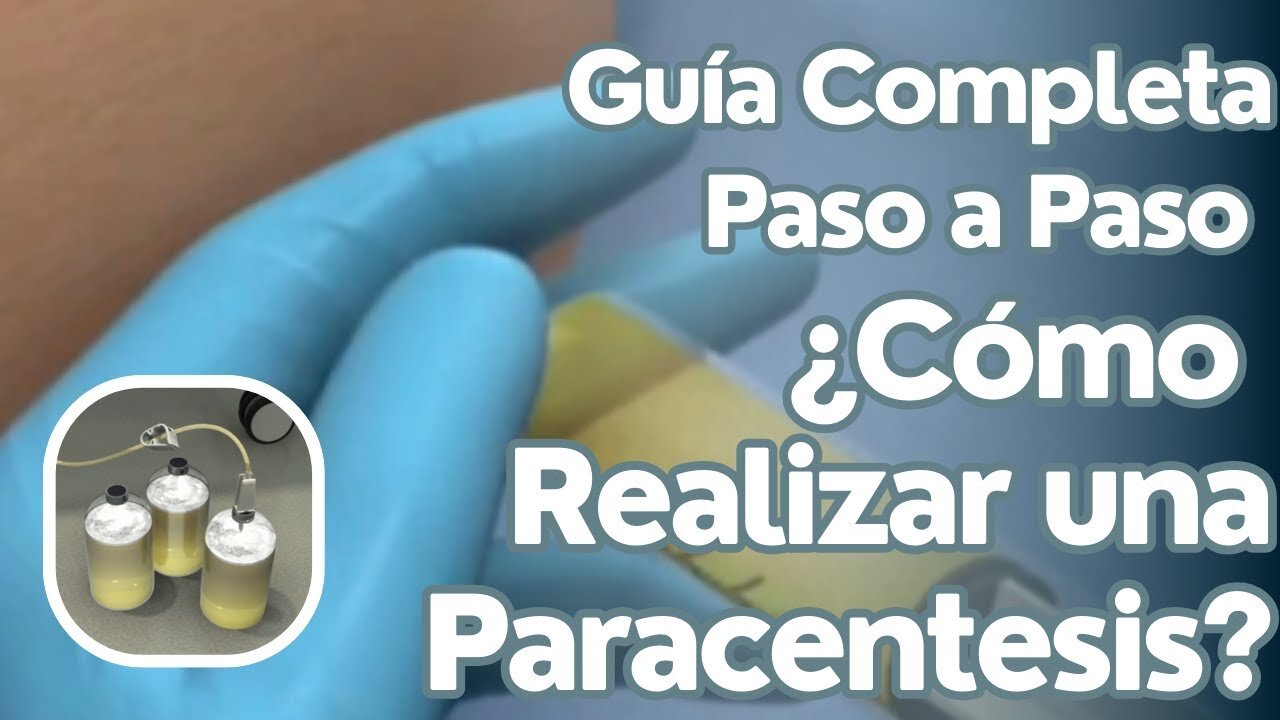 Paracentesis | Guía Paso a Paso para el Procedimiento Correcto