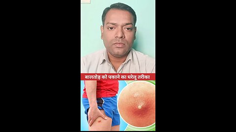 बालतोड़ को पकाने का घरेलू तरीका ।