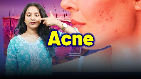 Acne Homeopathy Cure .| Dr. Bharadwaz | Homeopathy, Medicine & Surgery