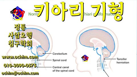 키아리 기형 원인과 치료 및 후기 - 사암오행침, 사암침법, 오행침, 정통사암침