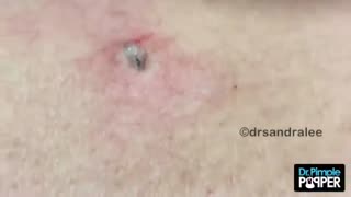 The BEST OF Softpops 2015 for 2018 Part 1 Dr Pimple Popper