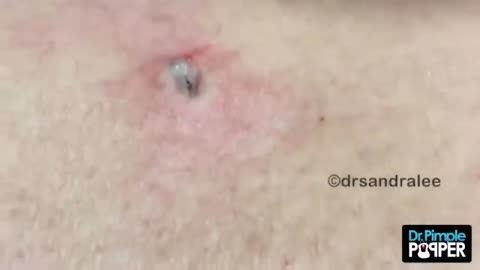 The BEST OF Softpops 2015 for 2018 Part 1 Dr Pimple Popper