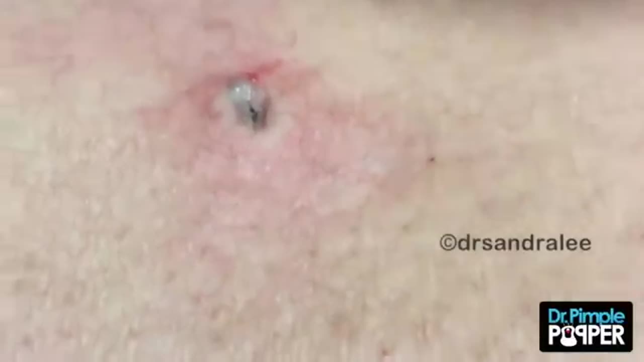 The BEST OF Softpops 2015 for 2018 Part 1 Dr Pimple Popper