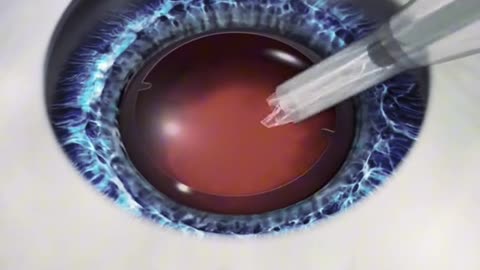 Cataract Surgery 3D Animation