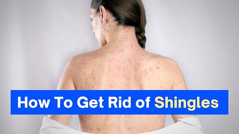 How to get rid of shingles