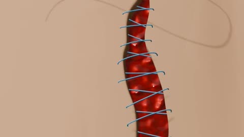 How Stitches Work In Human Body (Wound Healing Process)