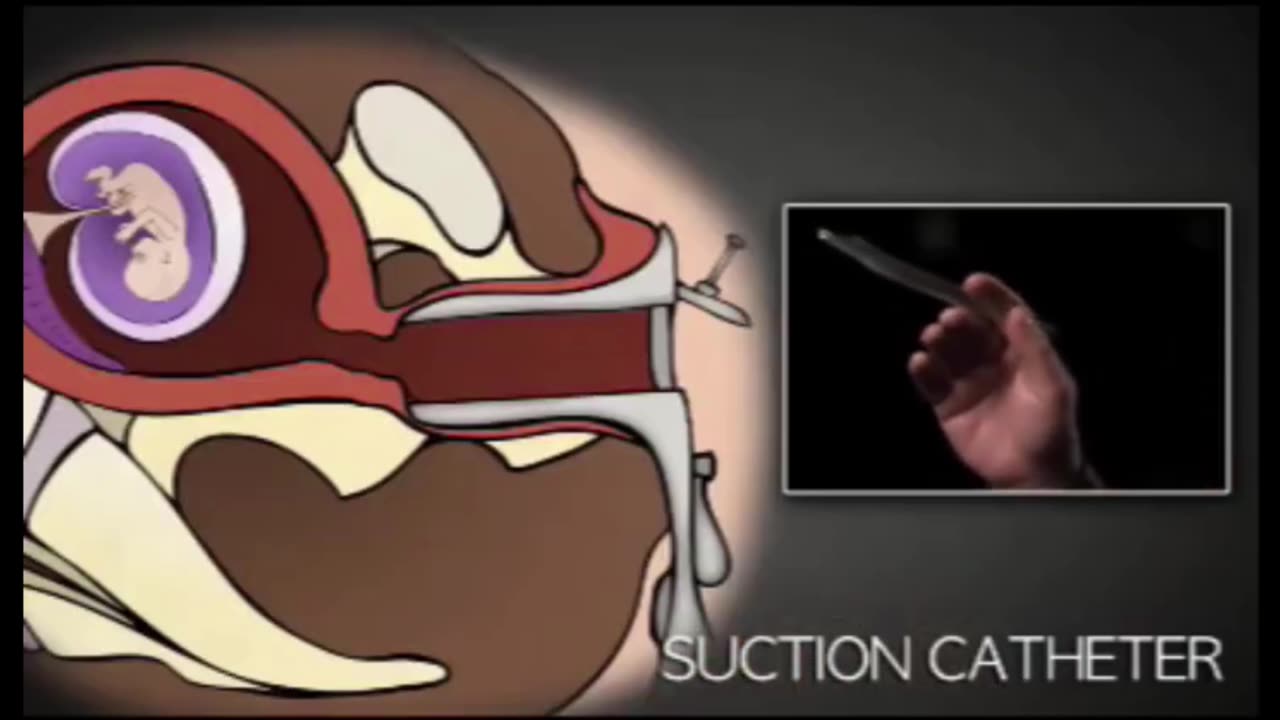 1st Trimester Surgical Abortion--this is what reproductive "freedom" looks like #