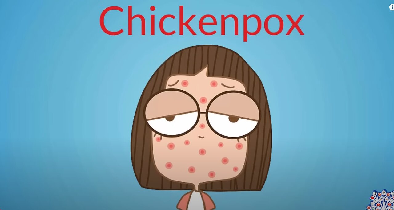 Chickenpox, Causes, Signs and Symptoms, Diagnosis and Treatment.