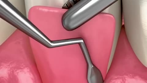 How They Fix Messed Up Gums 🦷