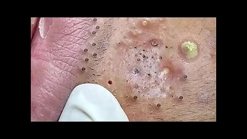 Relaxing Big Cystic Acne Blackheads ExtractionBlackheads & Milia, Whiteheads Removal Pimple Poppings