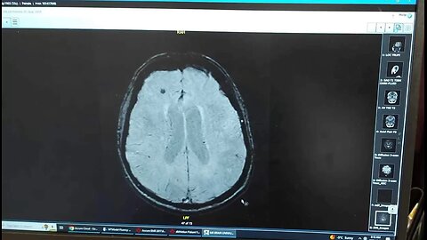 Cerebral Amyloid Angiopathy