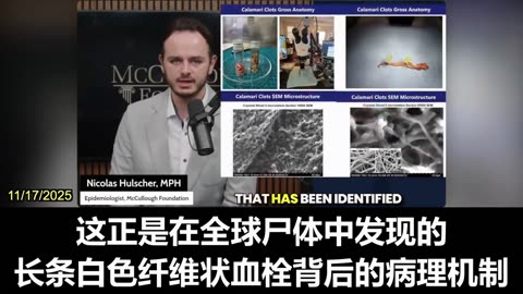 2025.11.17 COVID-19 vaccine has amyloid microclots in their blood