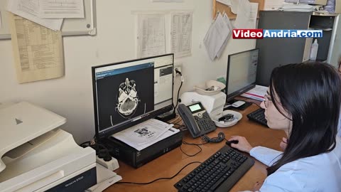 Andria: farmaco innovativo per il trattamento dell'Ictus utilizzato con successo in neurologia