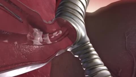 Mechanism Of Asthma Attack 3D Animation