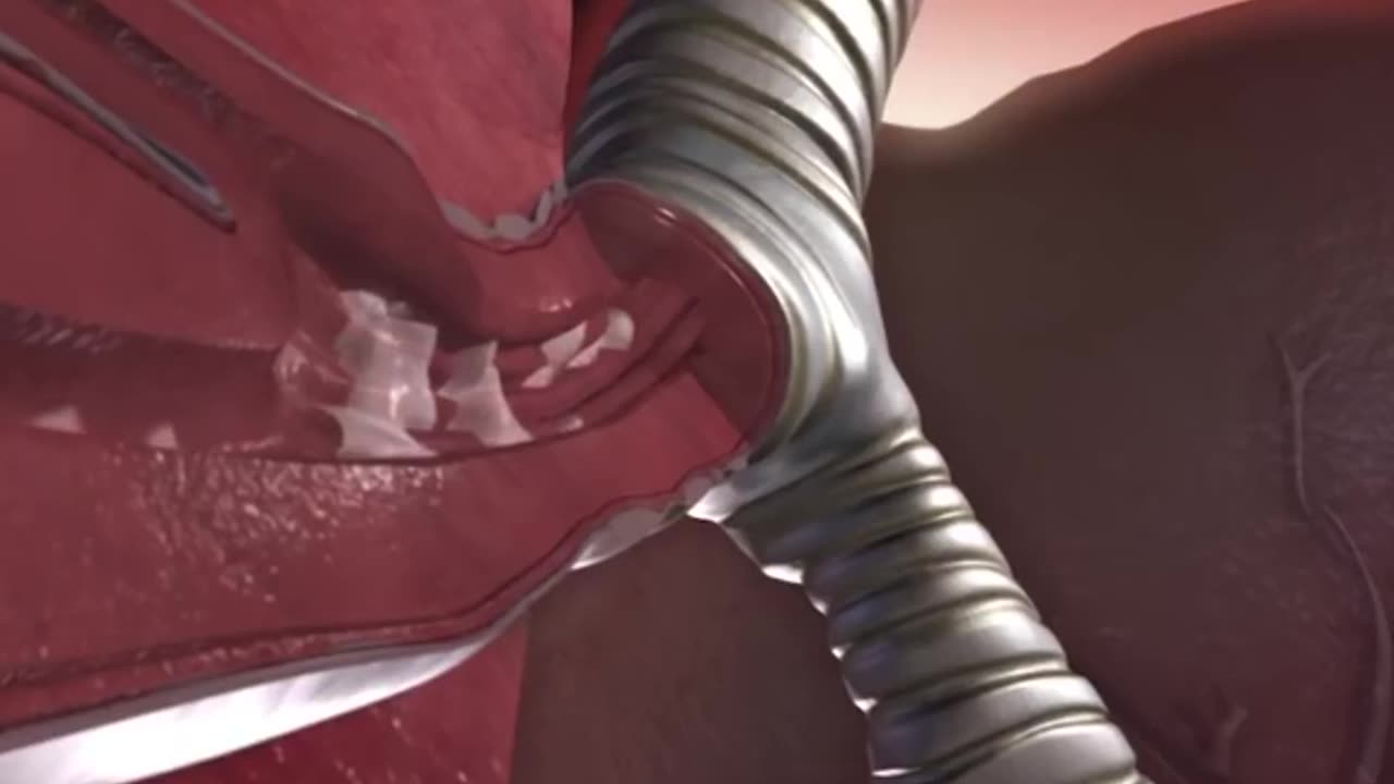 Mechanism Of Asthma Attack 3D Animation