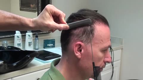 Dr. Brett Bolton Shows Incredible Hair Surgery Scar Healing