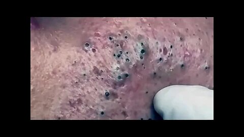 Blackhead removal with NaSa Spa | Satisfying and Relaxation with NaSa Beauty Spa