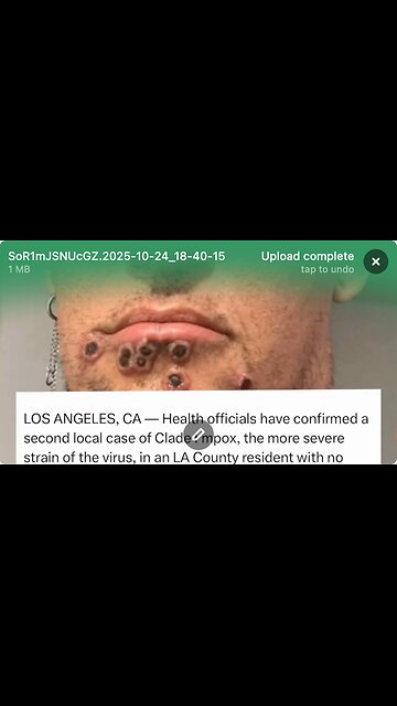 MONKEY POX IS BACK!!