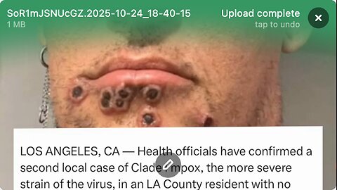 MONKEY POX IS BACK!!