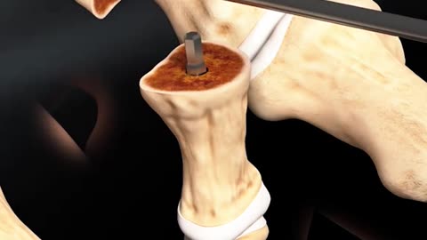 Hammertoe Repair Surgery 3D Animation