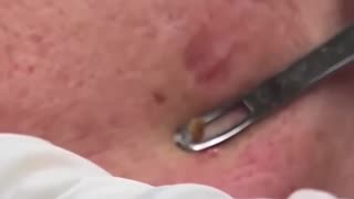 Creamiest Blackhead Dr Pimple Popper Pops MASSIVE Blackhead
