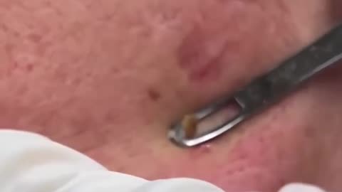 Creamiest Blackhead Dr Pimple Popper Pops MASSIVE Blackhead