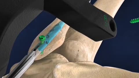 Fibula Nail Surgery — How Doctors Fix Broken Fibula Bone