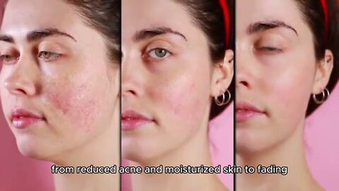 Clear Skin Breakthrough: How Zinamax Tackles Acne from Within