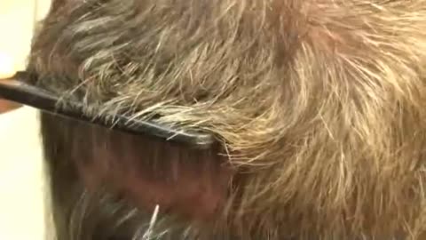 Dr. Brett Bolton Reveals His Secret to an Undetectable Hair Transplant Scar