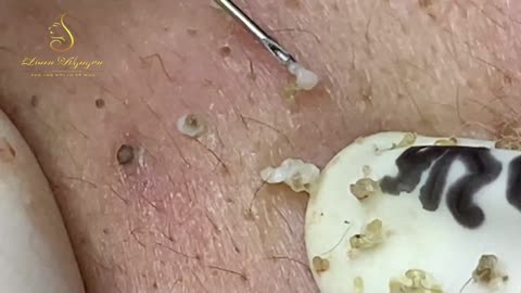 Blackheads removal