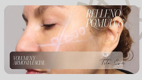 Relleno de Pómulos: Volumen y Armonía Facial