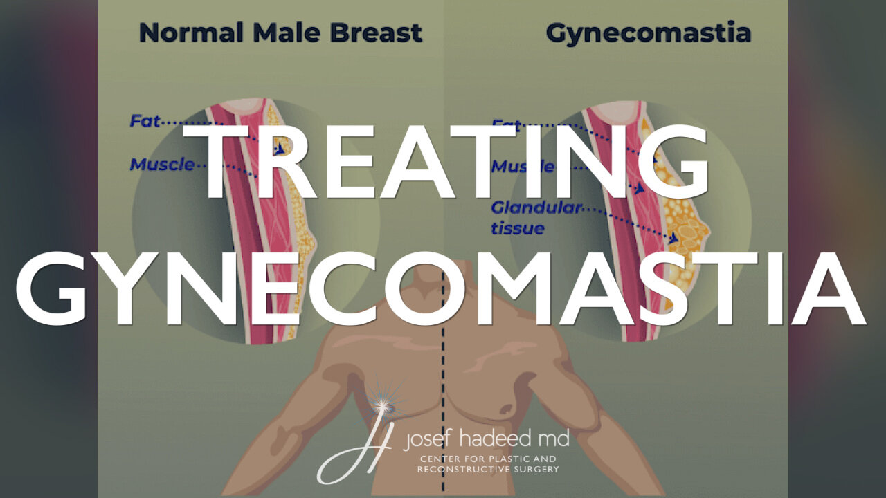 Treating Gynecomastia | Male Breast Tissue Correction
