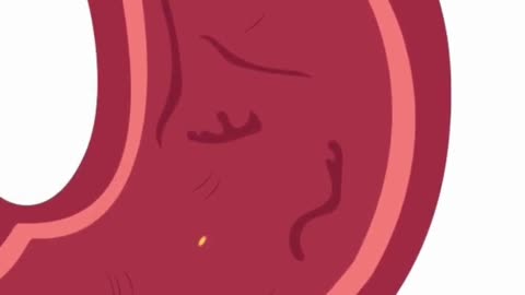 Iron Infusions: Are They the BEST Solution for Low Iron? #shorts