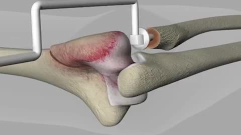 Radial Head Replacement Surgery 3D Animation