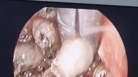 🤯✨ Watch a Child Get Worms Removed From Their Ear! | FeedMyCuriosity