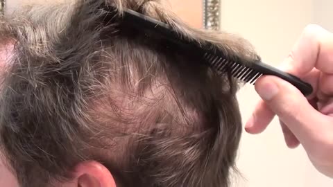 Dr. Brett Bolton Shows Undetectable Hair Restoration Scar