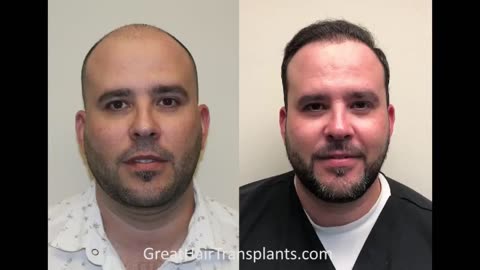 Dr. Brett Bolton MaxHarvest™ Hair Restoration Scar