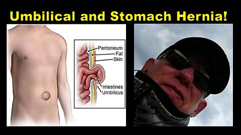 Kim Osbøl: Can you Treat Umbilical & Stomach Hernia Without Surgery? (Part 2) [26.02.2025]