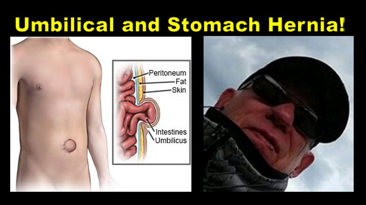 Kim Osbøl: Can you Treat Umbilical & Stomach Hernia Without Surgery? (Part 2) [26.02.2025]