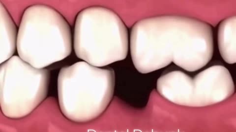 Do you have missing teeth or planning to remove tooth? #viral #trending #viraltoday