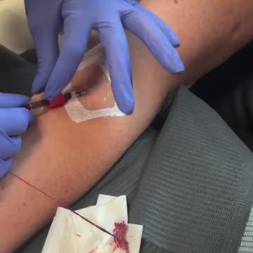 "You said you had the Pfizer vaccine right? Yes I did" Blood Clots