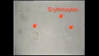 VIDEO PROOF: CANCER IS CAUSED BY PARASITES! LOOK!👀 - FULL DOCUMENTARY