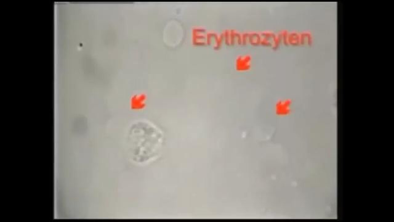 VIDEO PROOF: CANCER IS CAUSED BY PARASITES! LOOK!👀 - FULL DOCUMENTARY